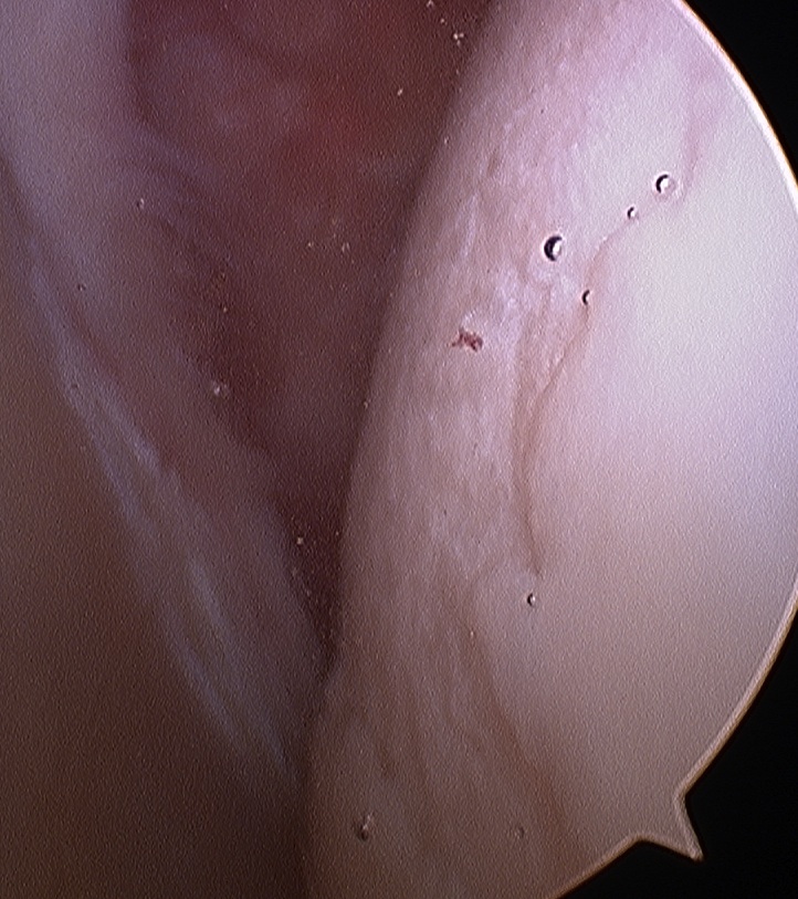 Arthroscopy Humeral Head OA